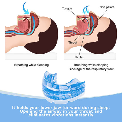 Anti-Snoring Mouth Guard